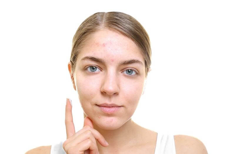 Acne Dos and Don'ts: What You Need To Know