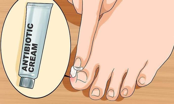 Ingrown Toenail - Foot Health Facts