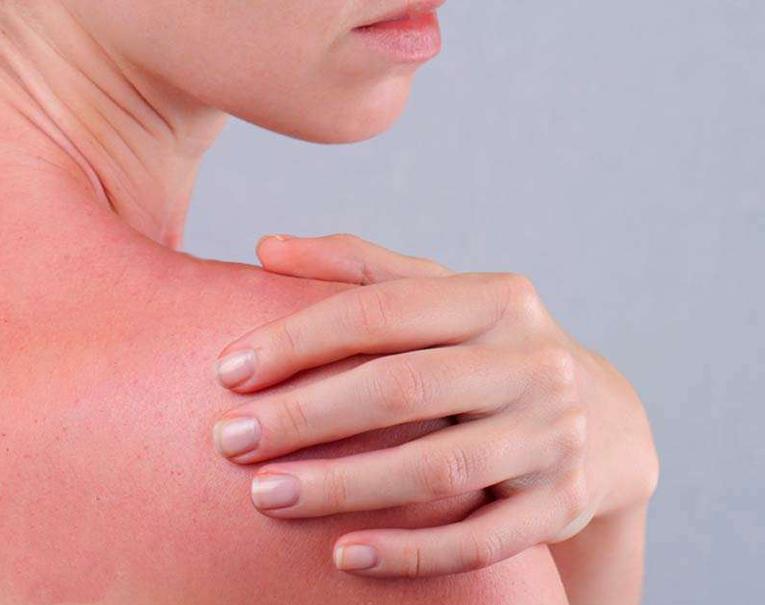 How To Heal Sunburned Skin