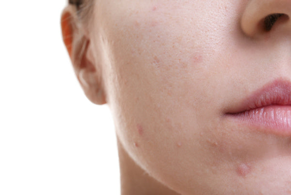 A Case of Hormone Triggered Acne