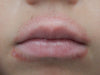 childhood lip eczema dermatitis 
