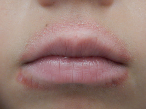 childhood lip eczema dermatitis 