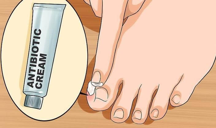 What Causes Toenail Fungus and How can I get Rid of it Before Summer?:  Premier Foot & Ankle: Podiatrists