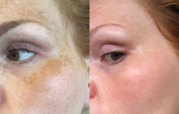 What is Melasma? - Facts, Prevention, Treatments & More - Seaside Medical Technologies