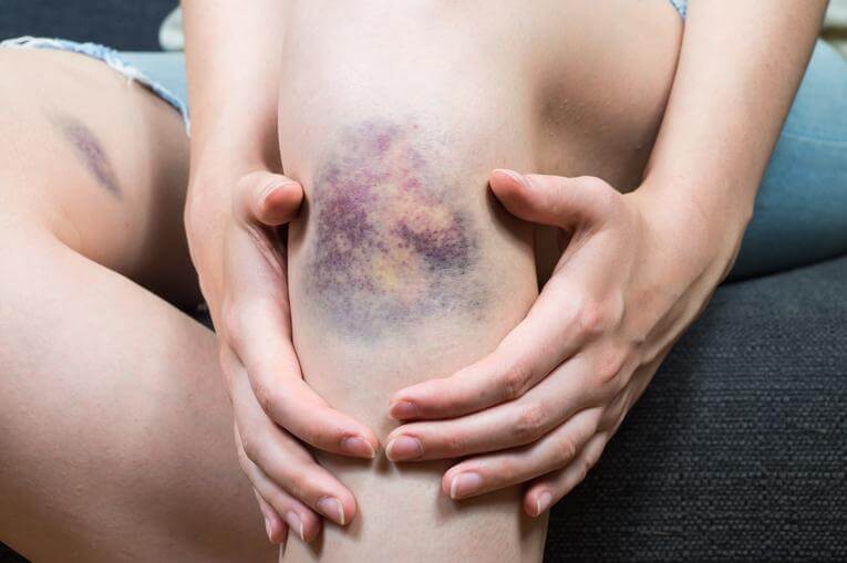How to Get Rid of Bruises: 5 Remedies You Need to Know
