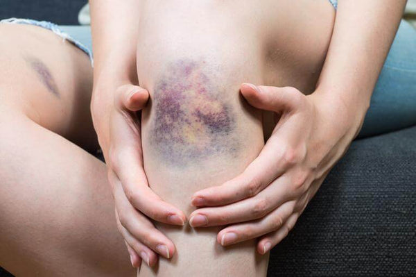 5 Tips to Get Rid of Bruises Quickly | Seaside Medical Technologies