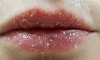 Lip Eczema Cured
