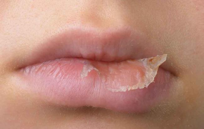 Eczema On The Lips - How To Relieve It