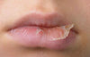 lip eczema 