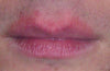 Dermatitis Around Lips